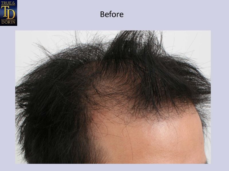 1 mg opinioni finasteride